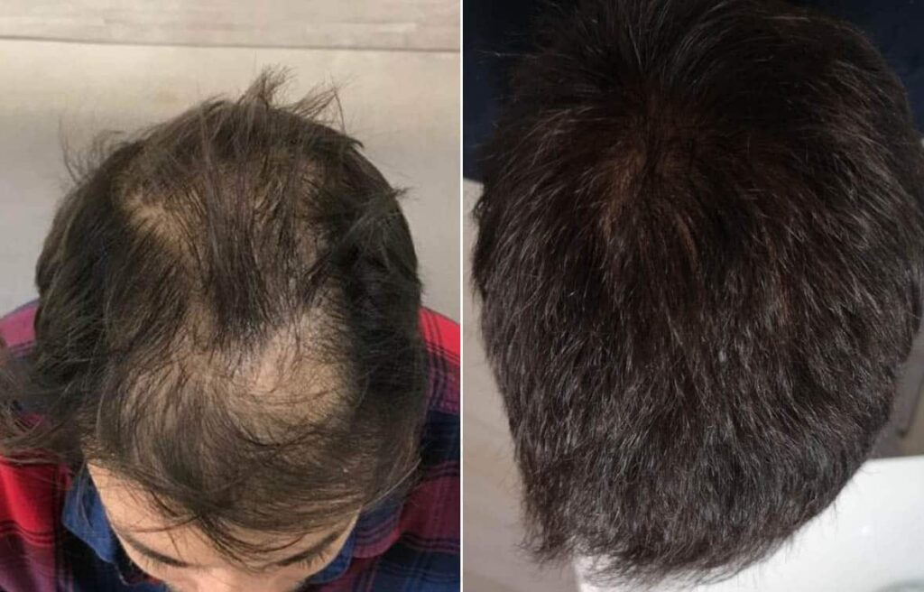 Hair Transplant