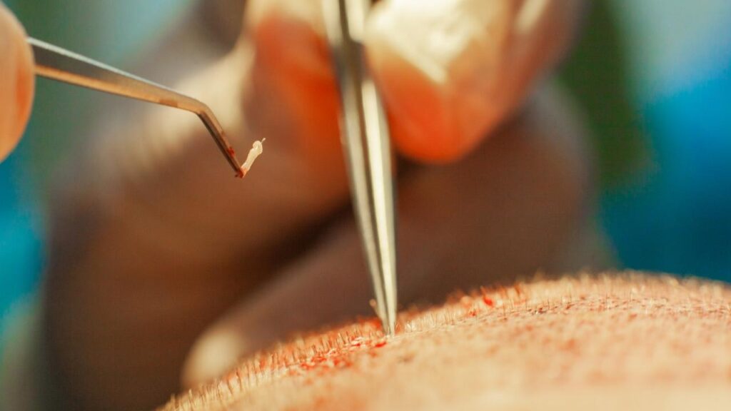 Hair Transplant