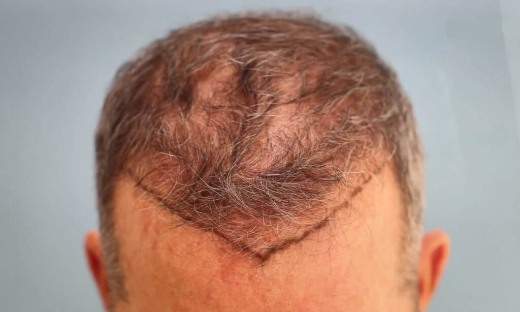Hair Transplant