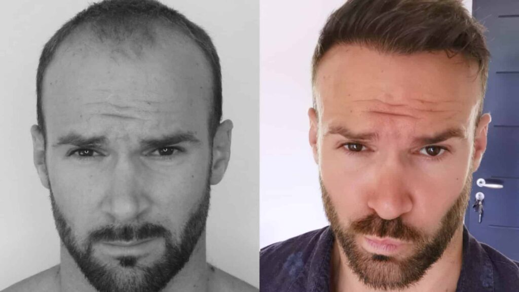 Hair Transplants