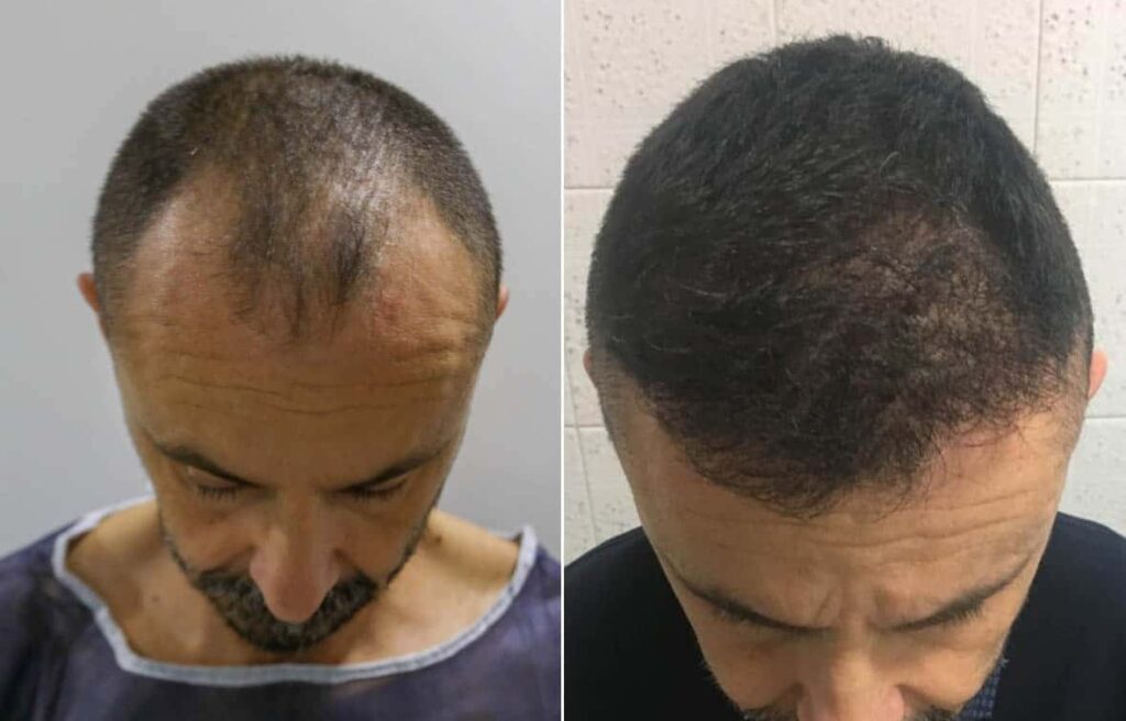 Hair Transplant