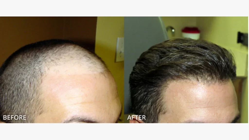 hair transpiant