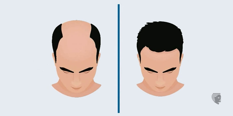 Hair Transplant