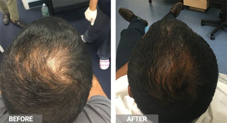 Hair Transplant