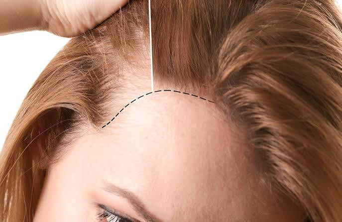 Hair Transplant for Women