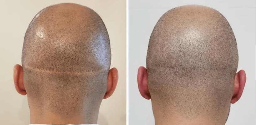 Hair Transplant