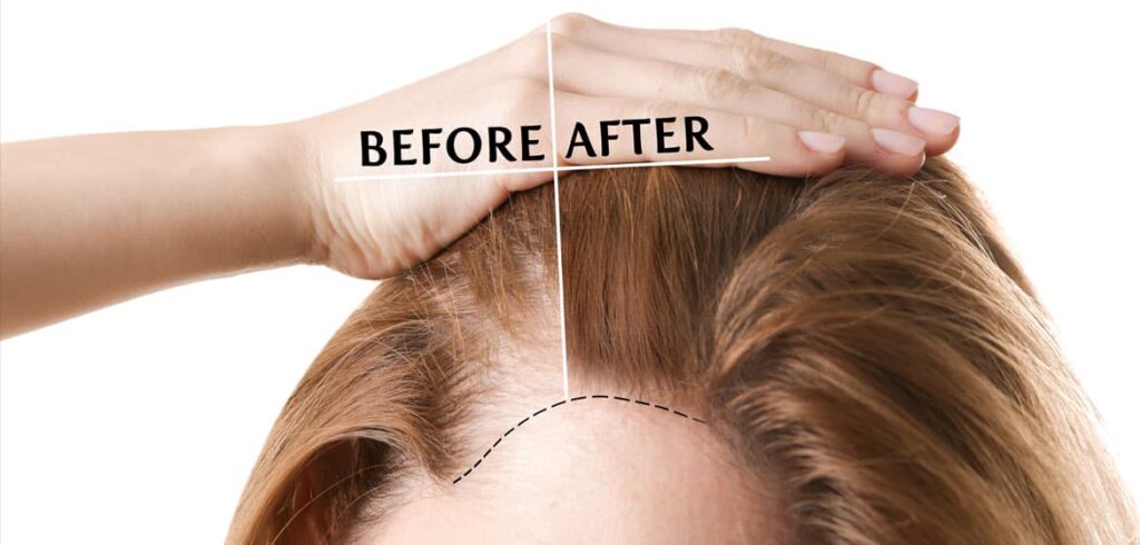 Hair Transplant for Women