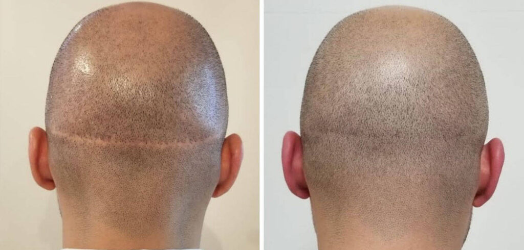 Hair Transplant