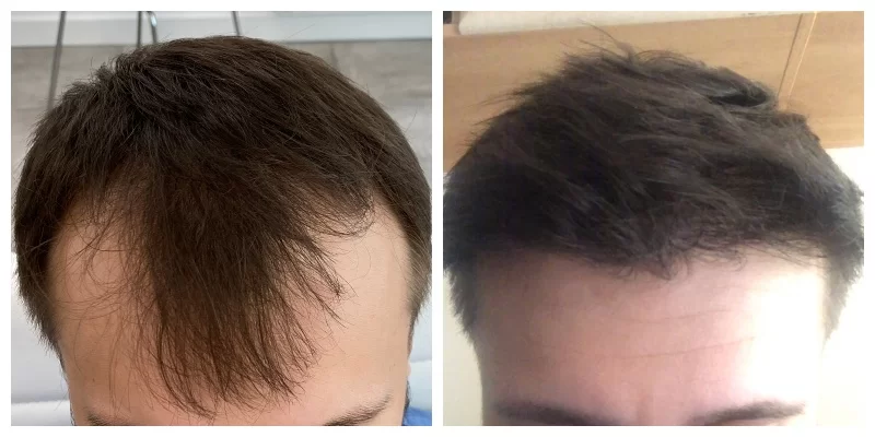 Hair Transplant