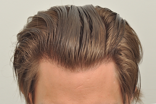Hair Transplant