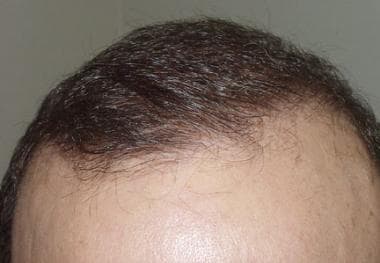 Hair Transplant