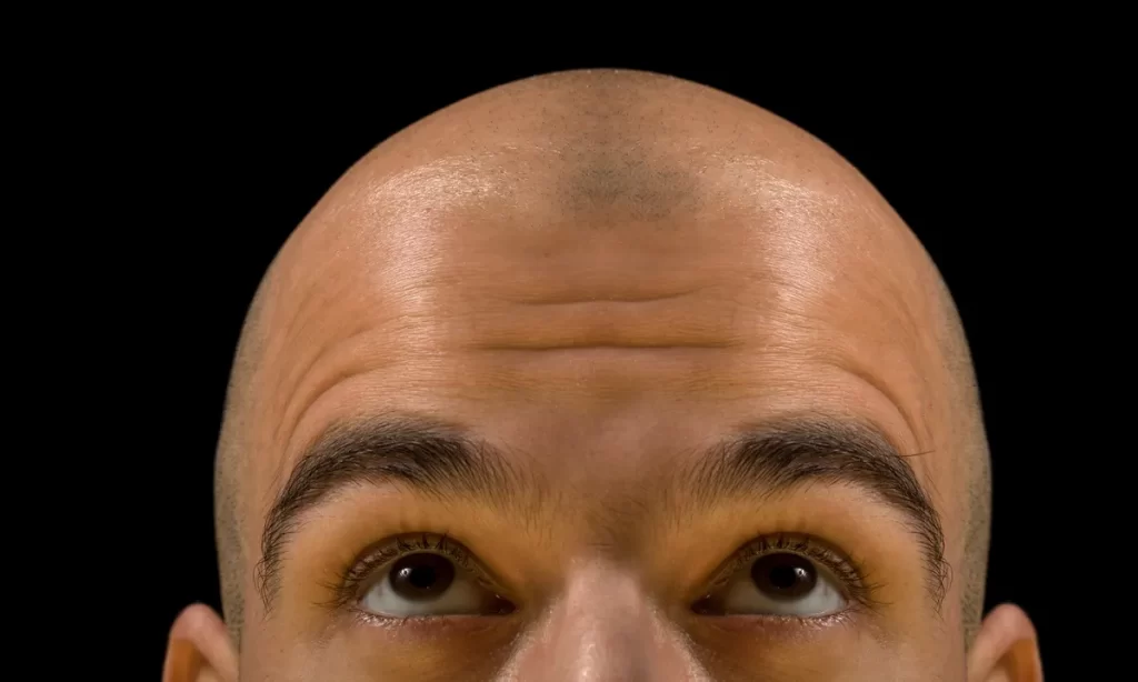 Hair Transplant