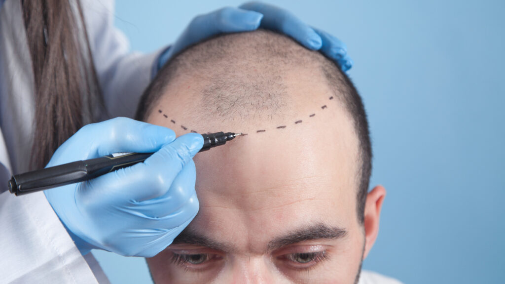 Hair Transplant
