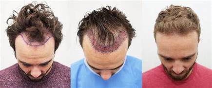 Hair Transplant Clinic
