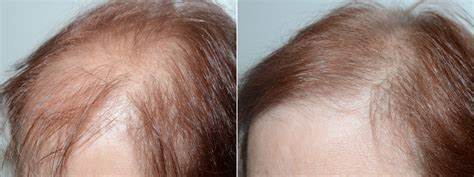 Hair Transplant
