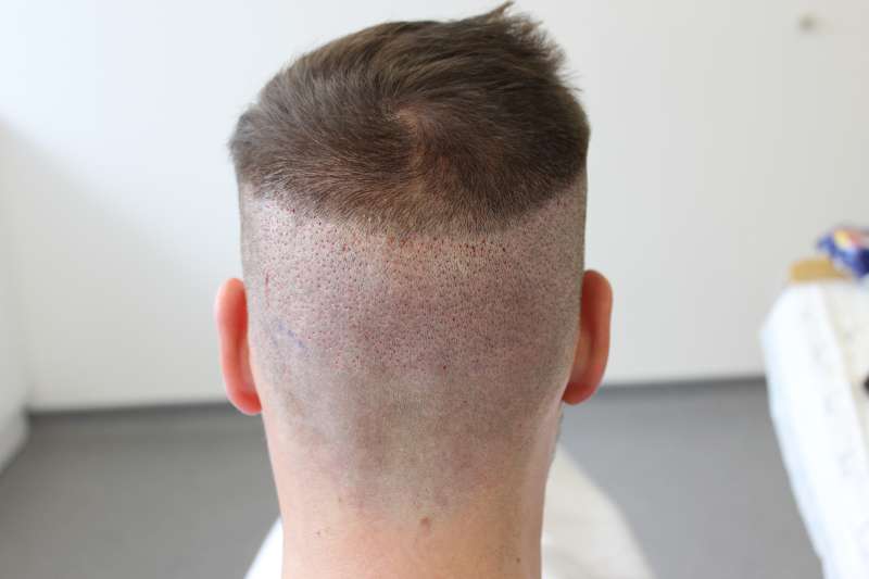 Post-Hair Transplant Surgery