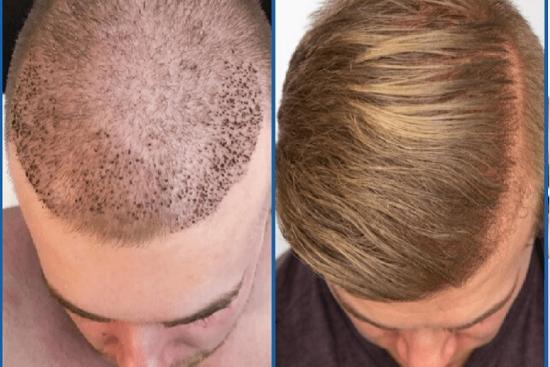 Hair Transplant Cost