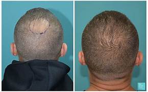 Hair Transplant