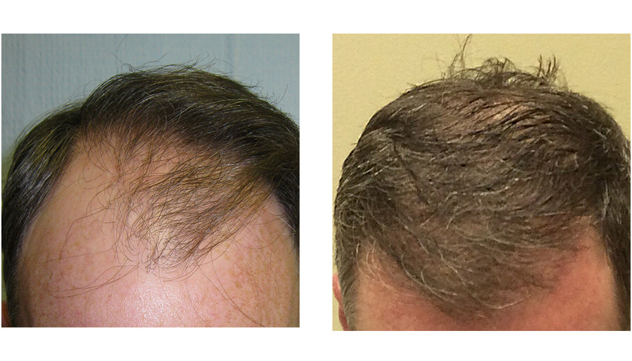 Hair Transplant