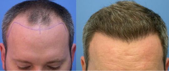Hair Transplant
