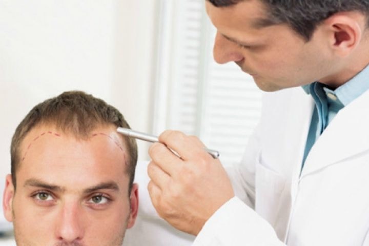 Hair Transplant