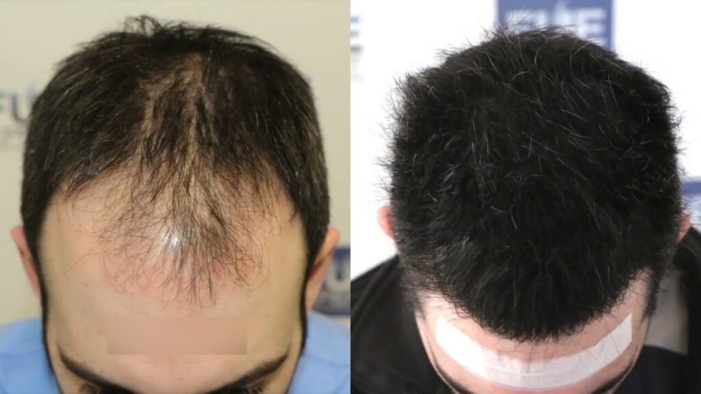 Hair Transplant