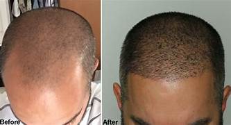 Hair Transplant Treatment