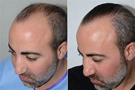 Hair Transplant