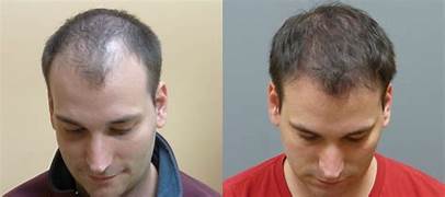 hair transplant