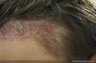 Hair Transplants