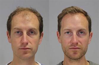 hair transplant