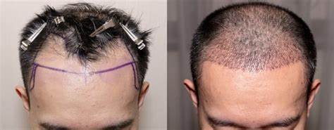 hair transplant