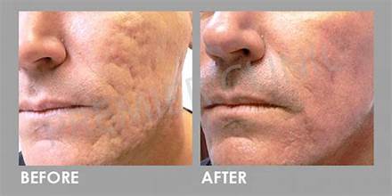 Acne Scar Subsicion Treatment