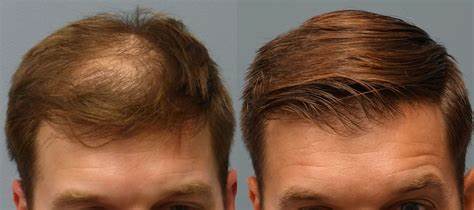 Nano FUE Hair Transplant
