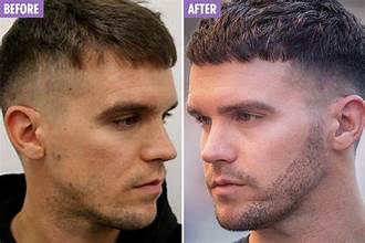 Beard Transplant