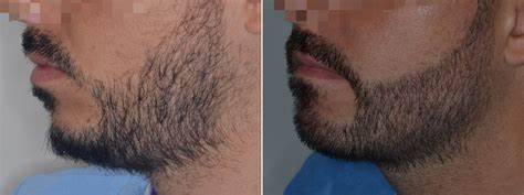 Beard Transplant