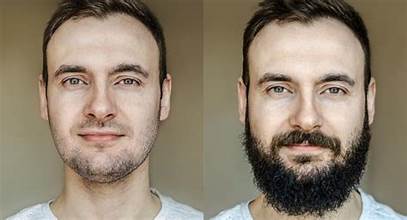 Beard Transplant