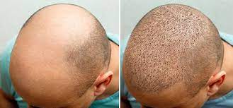 Hair Transplant
