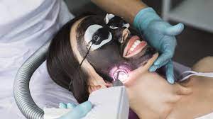 Carbon Peel Treatments