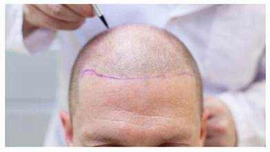 Hair Transplant