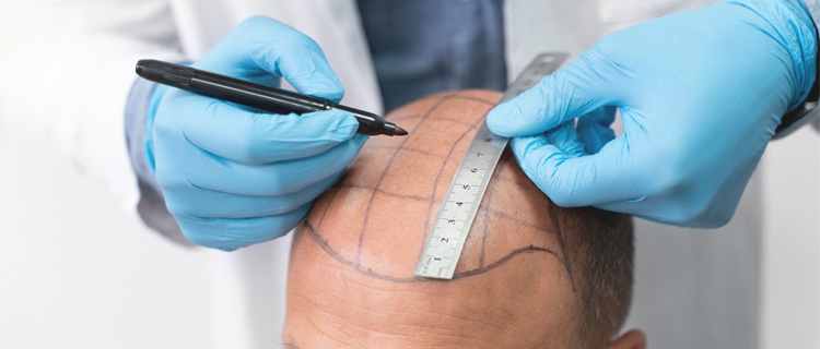 Hair Transplant