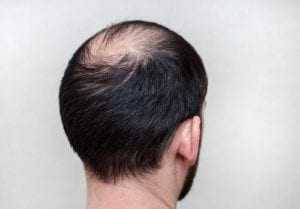 Hair Transplant