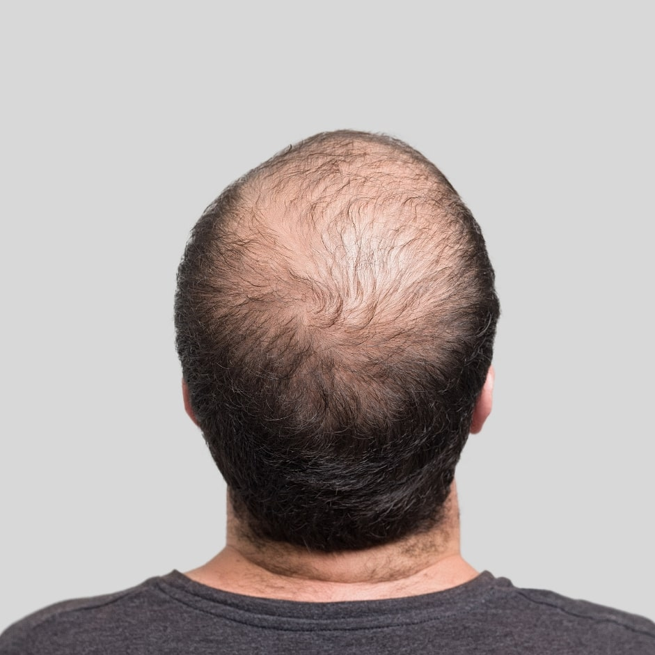 Hair Transplant