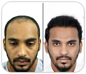 Hair Transplant