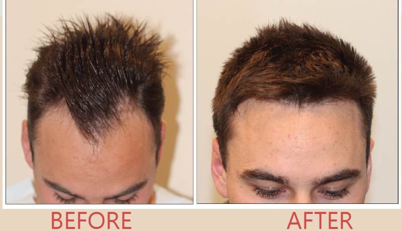 Hair Transplant