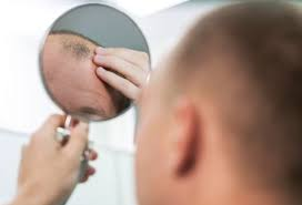 Hair Transplant