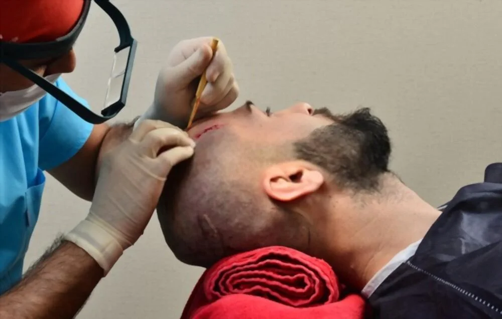 Hair Transplant