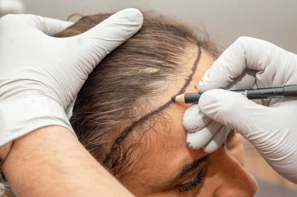 Hair Transplant